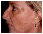Melasma_b